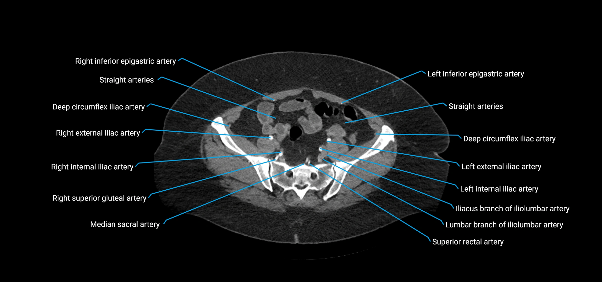 CTA abdomen axial cross sectional anatomy labelled image_194 (2).webp